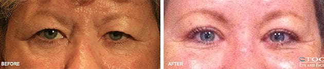 Endoscopic Brow Lift 3 - Cosmetic Surgery - TOC Eye and Face