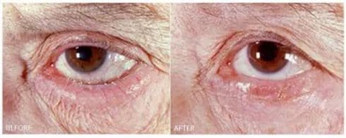 Entropion - Eyelid Turning In - Reconstructive Surgery - TOC Eye and Face