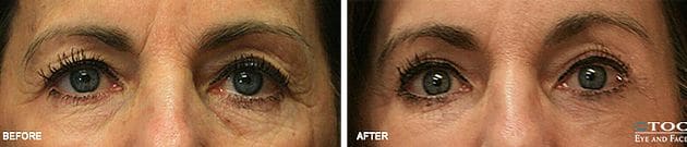Eyebrow Ptosis 1 - Reconstructive Surgery - TOC Eye and Face