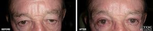 Eyebrow Ptosis 2 - Reconstructive Surgery - TOC Eye and Face