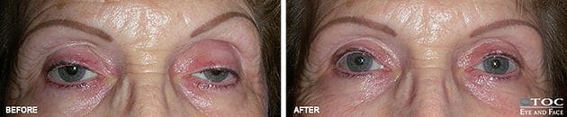 Eyelid Ptosis 1 - Reconstructive Surgery - TOC Eye and Face