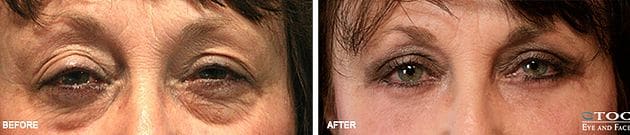 Eyelid Ptosis 2 - Reconstructive Surgery - TOC Eye and Face