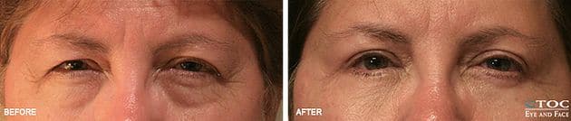 Eyelid Ptosis 3 - Reconstructive Surgery - TOC Eye and Face