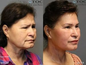 Facelift & Necklift - Cosmetic Surgery - TOC Eye and Face