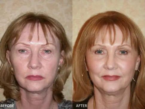 Fat Transfer - Cosmetic Surgery - TOC Eye and Face