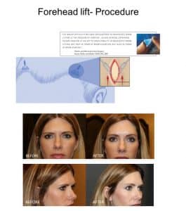 Forehead-Lift Procedure