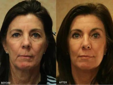 Laser Skin Resurfacing - Cosmetic Surgery - TOC Eye and Face