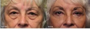 Lower Blepharoplasty 2 - Lower Eyelid Surgery - Cosmetic Surgery - TOC Eye and Face