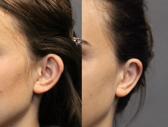 Otoplasty - Ear Reshaping Surgery - Cosmetic Surgery - TOC Eye and Face