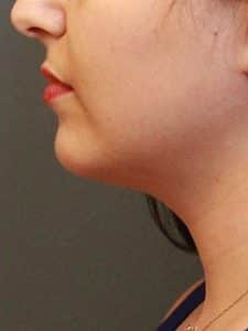 Patient 107 - Chin Implants - After