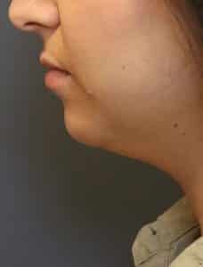 Patient 107 - Chin Implants - Before