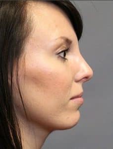 Patient 116 - Rhinoplasty & Repair of the Nose - After