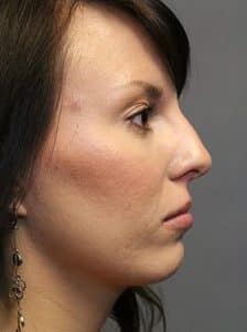 Patient 116 - Rhinoplasty & Repair of the Nose - Before