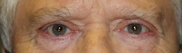 Patient 129 - Eyelid Ptosis - After