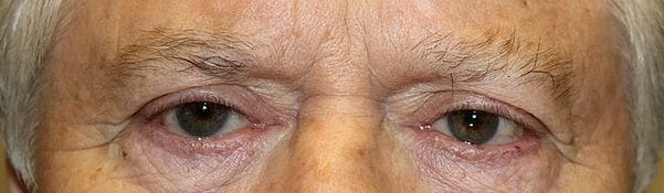 Patient 129 - Eyelid Ptosis - Before