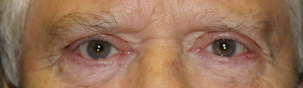 Patient 129 - Upper Blepharoplasty - Upper Eyelid Surgery - After