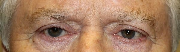 Patient 129 - Upper Blepharoplasty - Upper Eyelid Surgery - Before