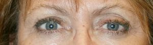 Patient 130 - Thyroid Eye Disease - Grves' Disease - After
