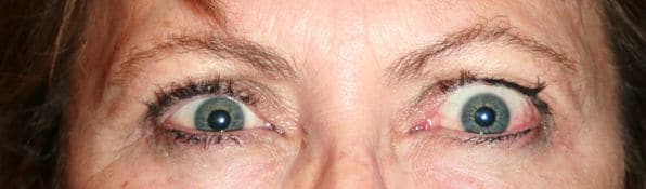 Patient 130 - Thyroid Eye Disease - Grves' Disease - Before