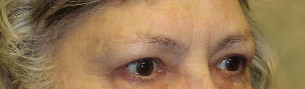 Patient 138 - Upper Blepharoplasty - Upper Eyelid Surgery - After
