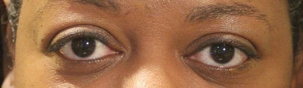 Patient 139 - Thyroid Eye Disease - Grves' Disease - After