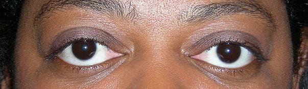 Patient 139 - Thyroid Eye Disease - Grves' Disease - Before