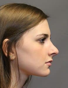 Patient 154 - Rhinoplasty & Repair of the Nose - After