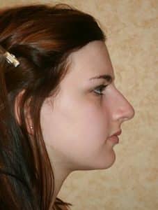 Patient 154 - Rhinoplasty & Repair of the Nose - Before