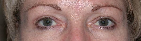 Patient 165 - Upper Blepharoplasty - Upper Eyelid Surgery - After