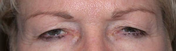 Patient 203 - Upper Blepharoplasty - Upper Eyelid Surgery - After