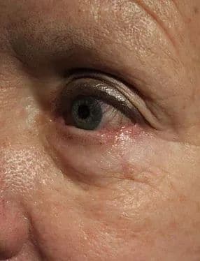 Patient 181 - Skin Cancer of the Eye and Face - After