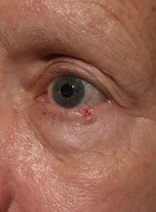 Patient 181 - Skin Cancer of the Eye and Face - Before