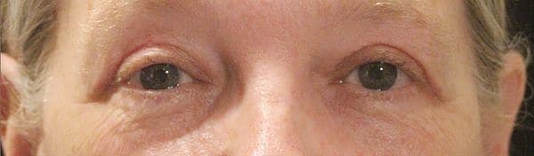 Patient 182 - Eyelid Ptosis - After