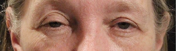 Patient 182 - Eyelid Ptosis - Before