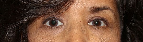 Patient 185 - Eyelid Ptosis - After