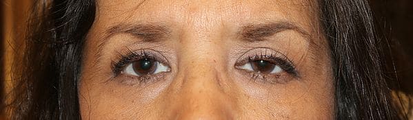 Patient 185 - Eyelid Ptosis - Before