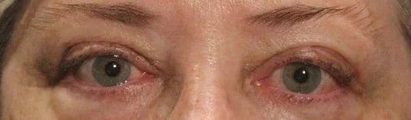 Patient 20 - Thyroid Eye Disease - Grves' Disease - After