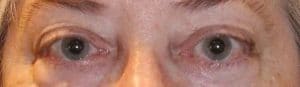 Patient 20 - Thyroid Eye Disease - Grves' Disease - Before