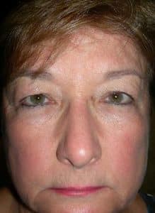 Patient 203 - Upper Blepharoplasty - Upper Eyelid Surgery - Before