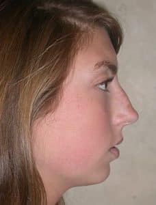 Patient 221 - Chin Implants - Before