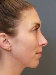 Patient 221 - Rhinoplasty & Repair of the Nose - After