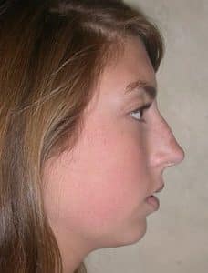 Patient 221 - Rhinoplasty & Repair of the Nose - Before