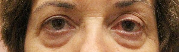 Patient 238 - Lower Blepharoplasty - Before