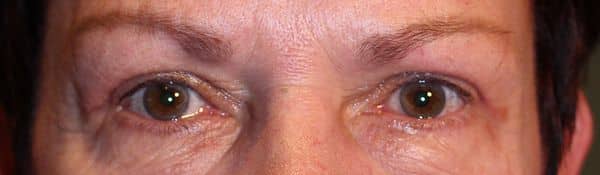 Patient 28 - Upper Blepharoplasty - Upper Eyelid Surgery - After
