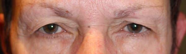 Patient 28 - Upper Blepharoplasty - Upper Eyelid Surgery - Before