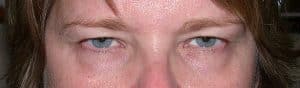Patient 31 - Upper Blepharoplasty - Upper Eyelid Surgery - Before