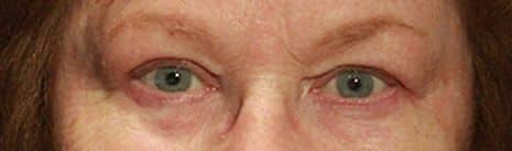 Patient 37 - Upper Blepharoplasty - Upper Eyelid Surgery - After