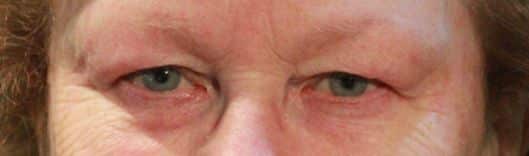 Patient 37 - Upper Blepharoplasty - Upper Eyelid Surgery - Before
