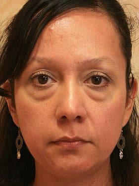 Patient 44 - Lower Blepharoplasty - Before