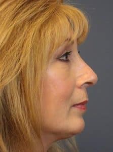 Patient 49 - Rhinoplasty & Repair of the Nose - After